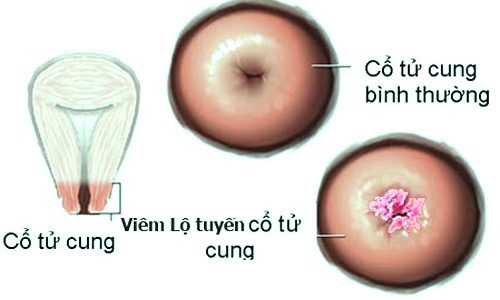 hình ảnh viêm lộ tuyến cở tử cung 