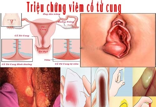 Viêm cổ tử cung