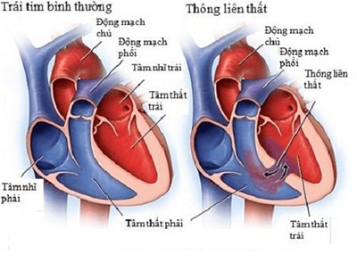 thong-lien-that-o-tre-nho